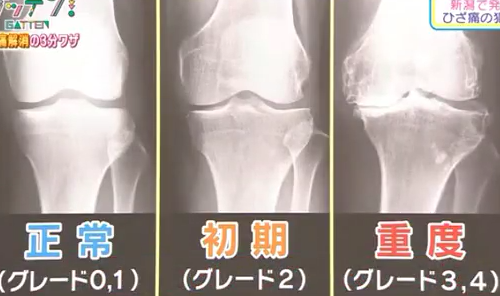 ためしてガッテン膝痛体操 膝伸ばし1日3分から 膝痛の原因は関節包 健康 資産管理法 リハビリ